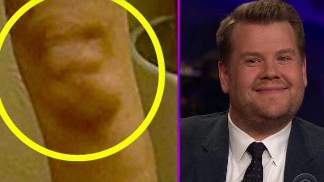 James Corden Knee