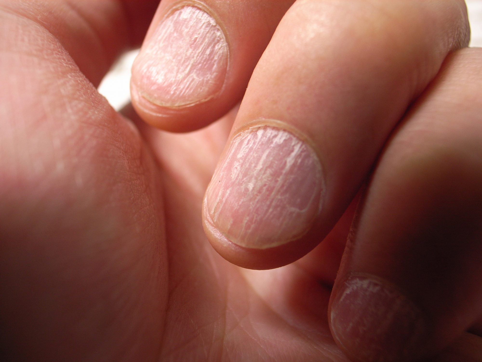 Brittle Nails and Hair Loss in Hypothyroidism - ppt download