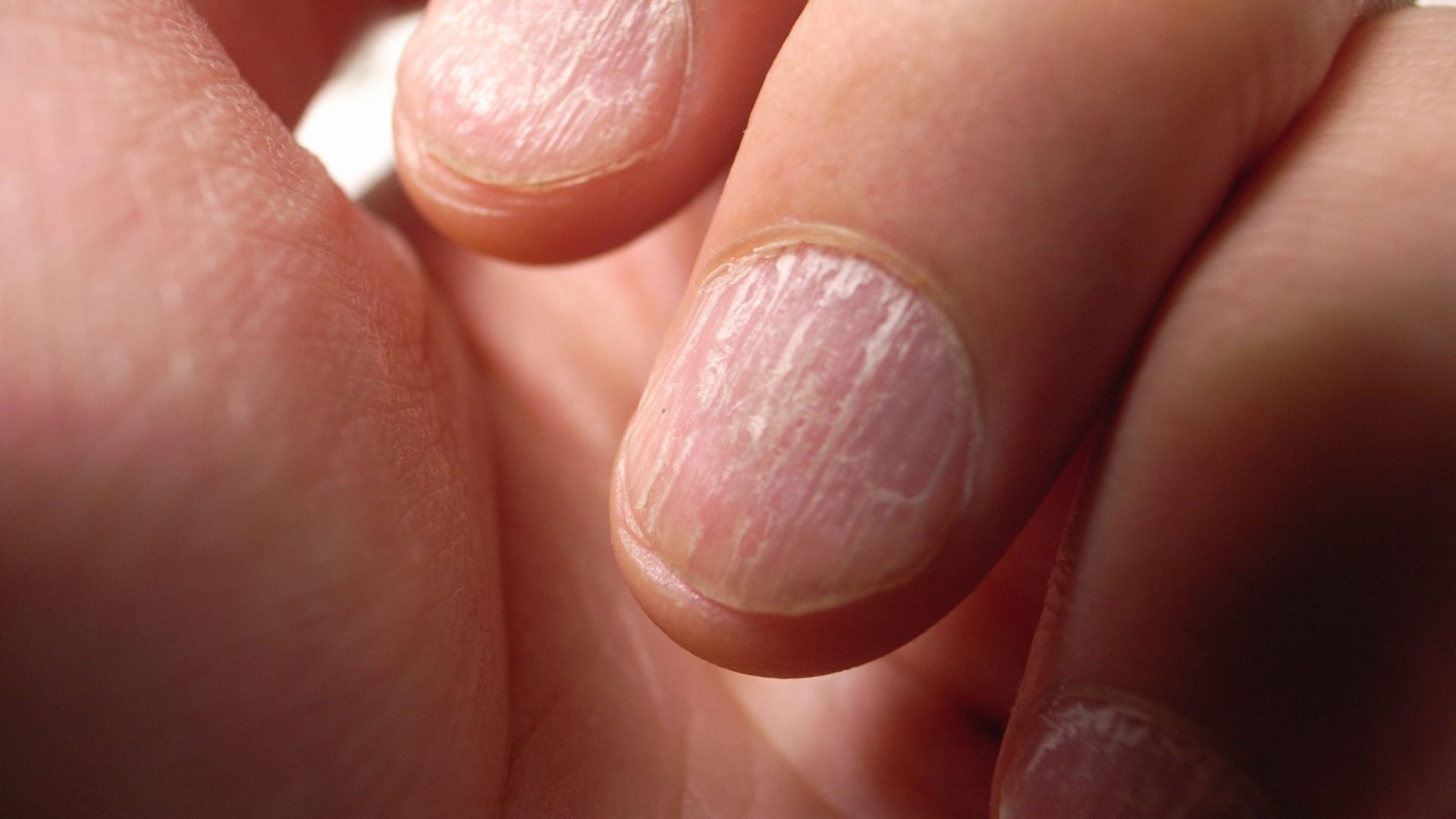 What these common nail problems could be telling you about your health - HelloGigglesHelloGiggles