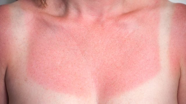 Closeup image of a white and red sunburned female chest