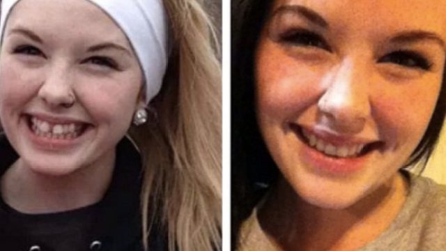 Picture of Invisalign Before and After Photo