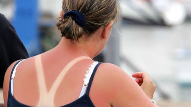 sunburned-getty-images