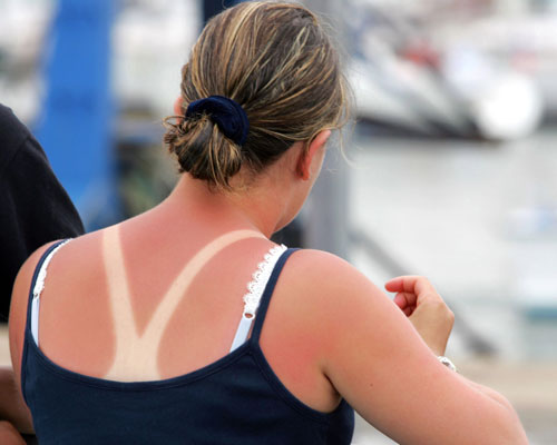 Sunburn Remedies to Try This Summer if Aloe Vera Just Won't Cut  itHelloGiggles