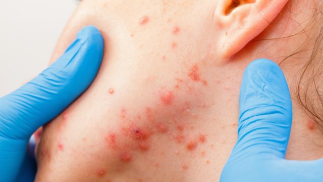 Acne skin