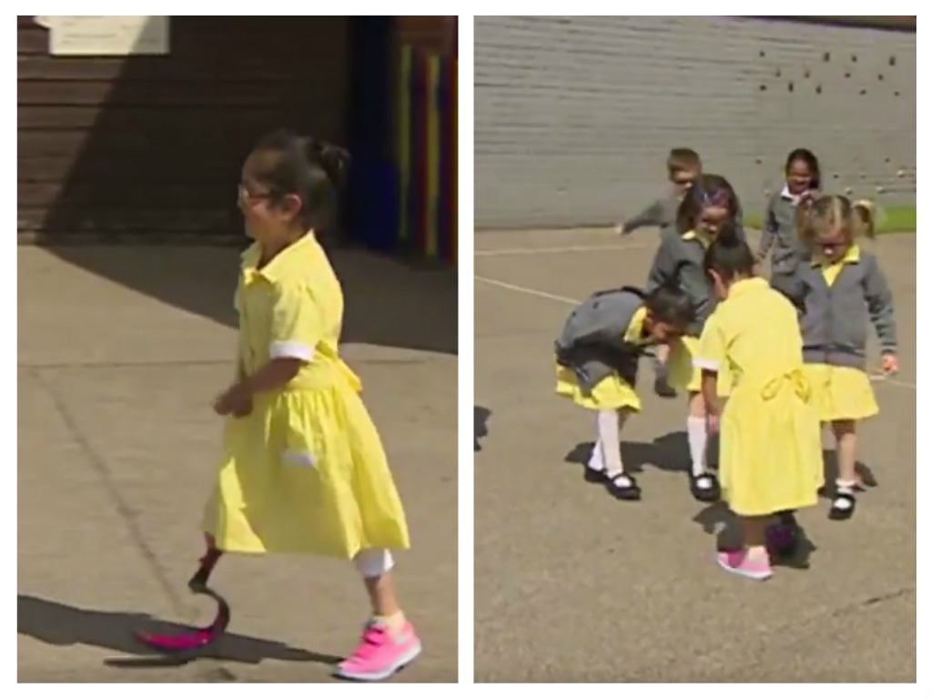 Amputee on the Move: Maria Makes Great Strides With Her New Prosthetic Leg!  