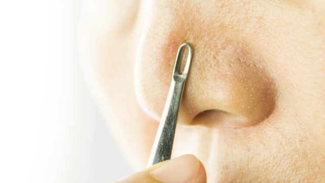 blackheads skin gritting