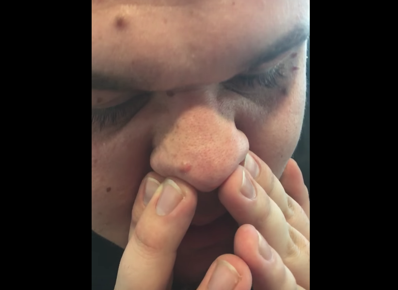 Hong Kong uitblinken afbreken Over 1 million people have watched this video of a man popping all his  blackheads at once - HelloGigglesHelloGiggles