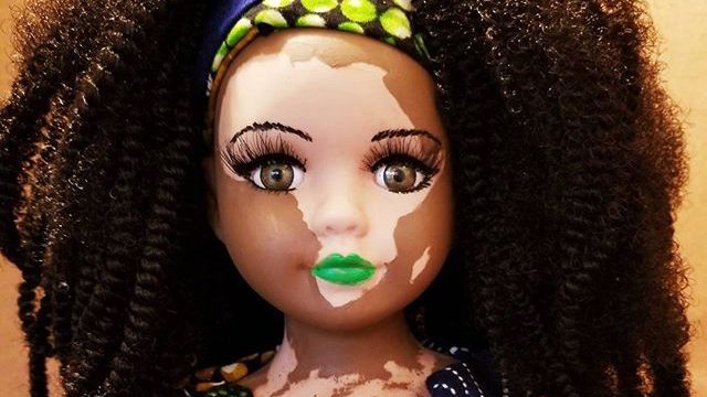 vitiligo doll