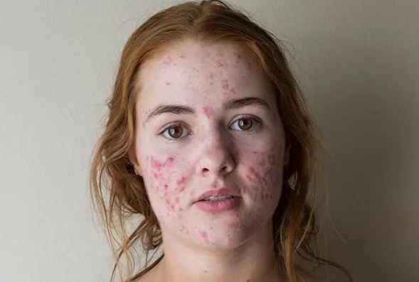 This Girls Before And After Acne Selfies Are Going Viral For An