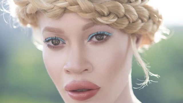 albino model