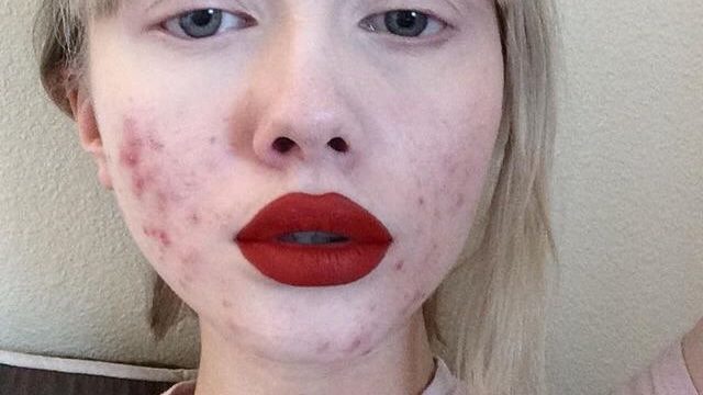 beautiful acne