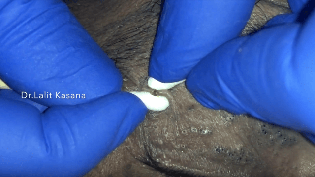 eyelid blackheads