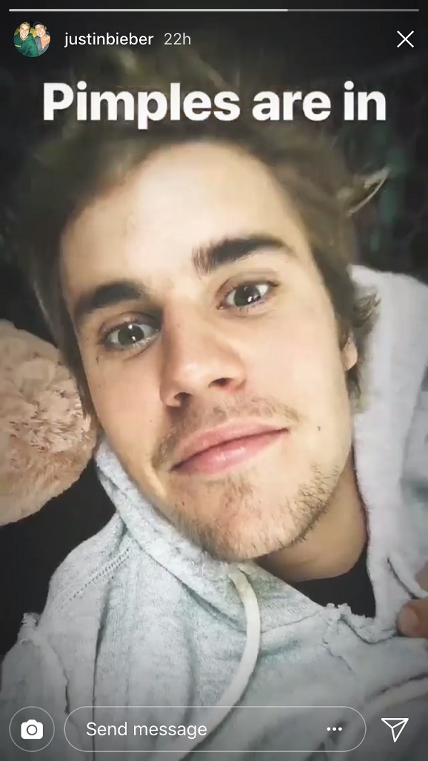 Justin Bieber Just Proved That Pimples Are Always In StyleHelloGiggles