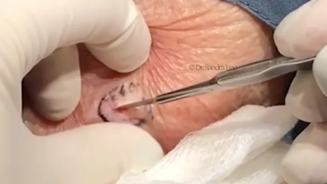 rose cyst doctor pimple popper