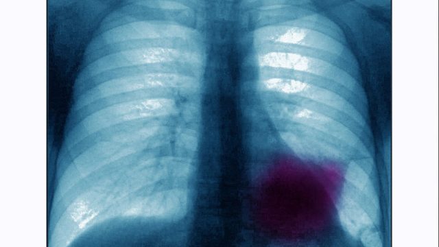 Lung cancer rates in women surpass those in men.