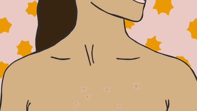 How To Prevent Chest Acne