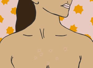 How To Prevent Chest Acne