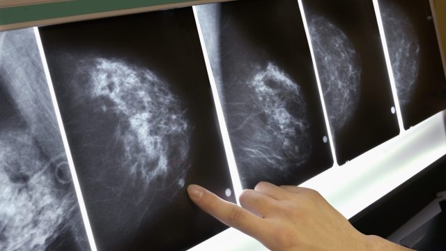 breast cancer myths