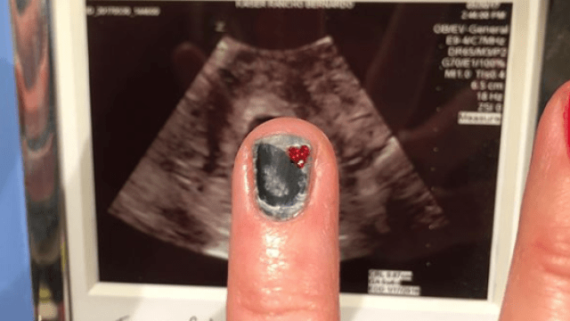 miscarriage