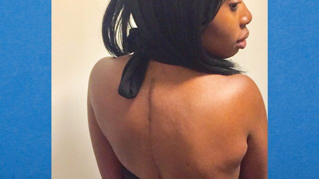 Author revealing her surgical scar