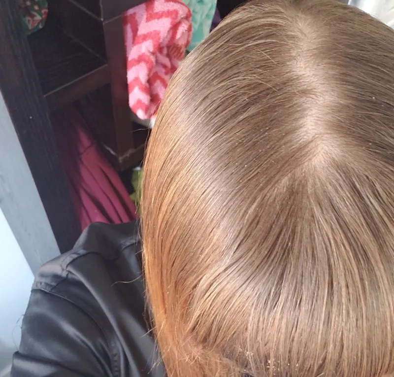 scalp-e1547409994783.jpg