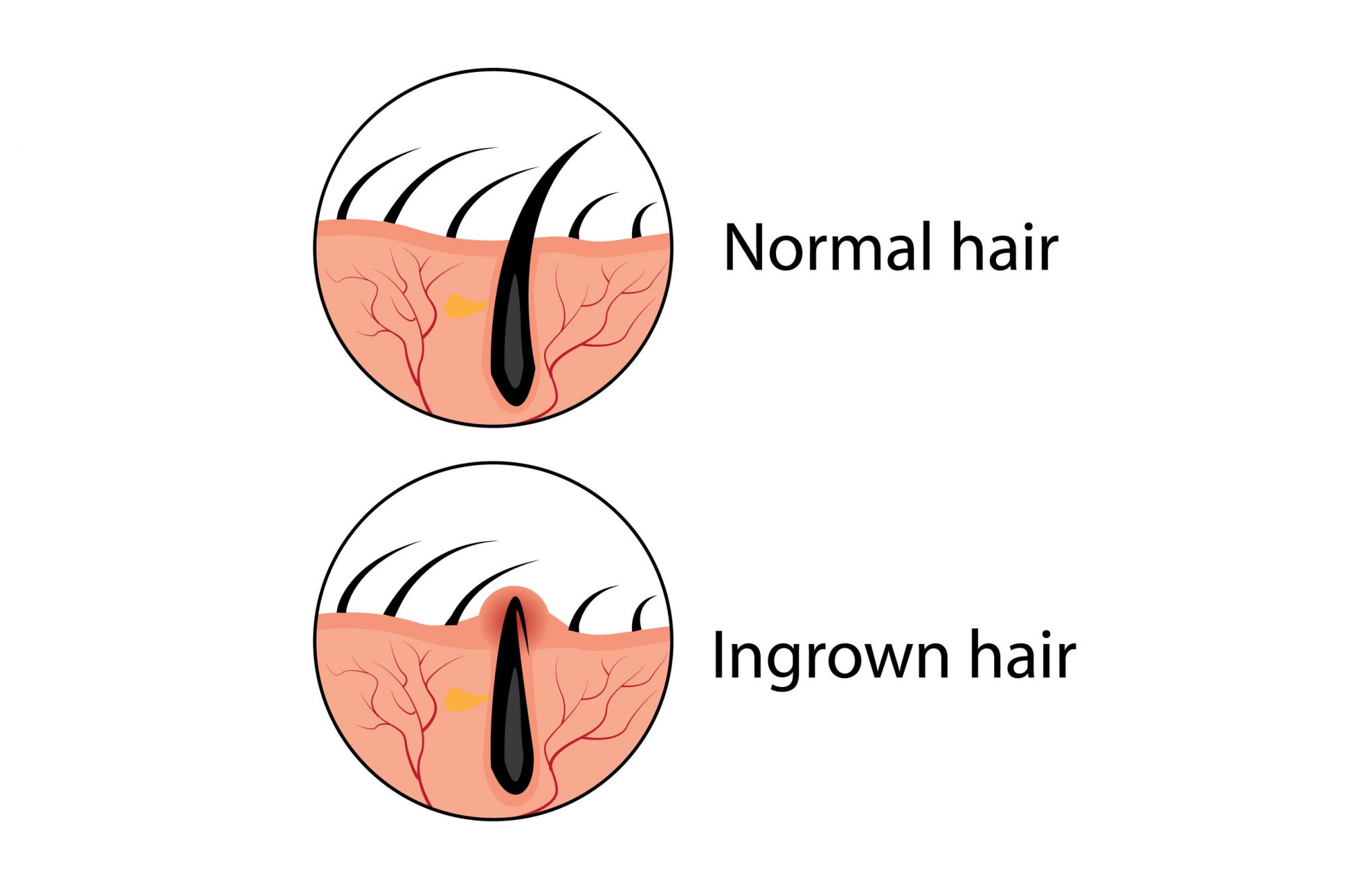 How To Get Rid Of An Ingrown Hair According To Expertshellogiggles 8712