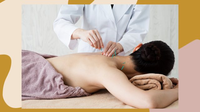 acupuncture, acupuncture benefits, acupuncture unexpected benefits, benefits of acupuncture, acupuncture needles, acupuncture for pain