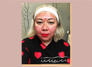 vampire facial before and after photos, what is a vampire facial