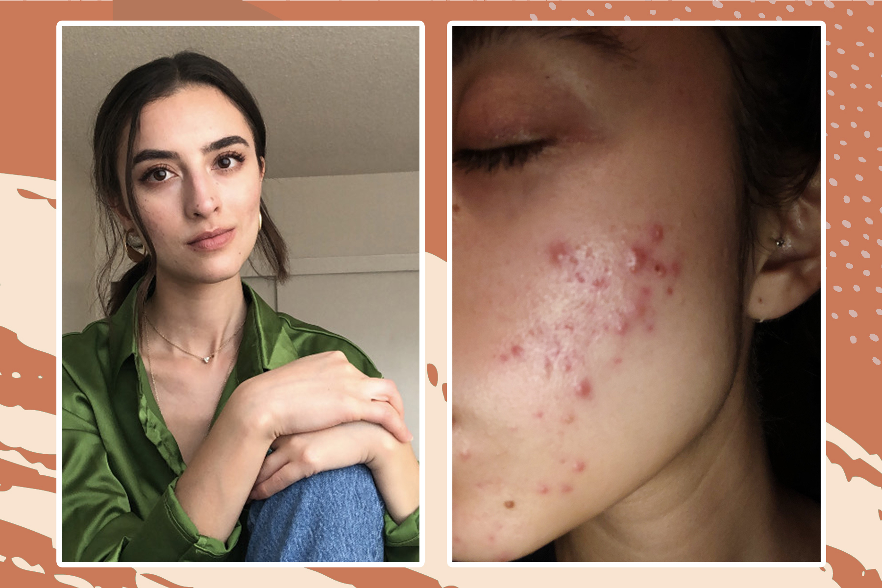 My Adult Acne Was Trying To Tell Me Something About My HealthHelloGiggles