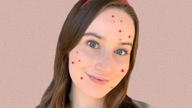 Accutane review