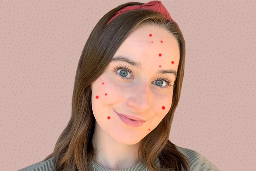 severe cystic acne accutane