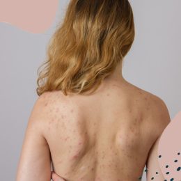 bacne back acne treatments