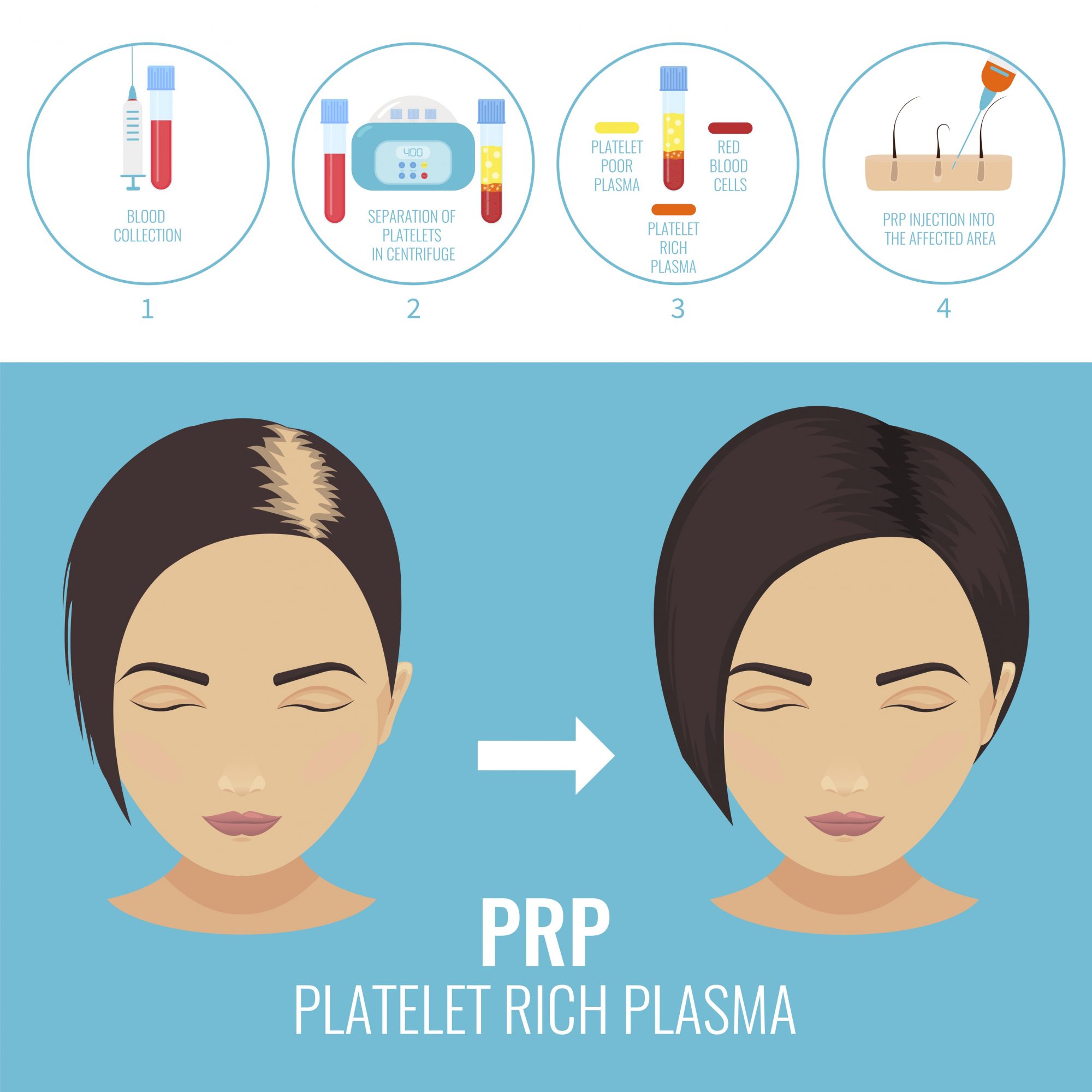 PRP Treatment for Hair Thinning and Hair LossHelloGiggles