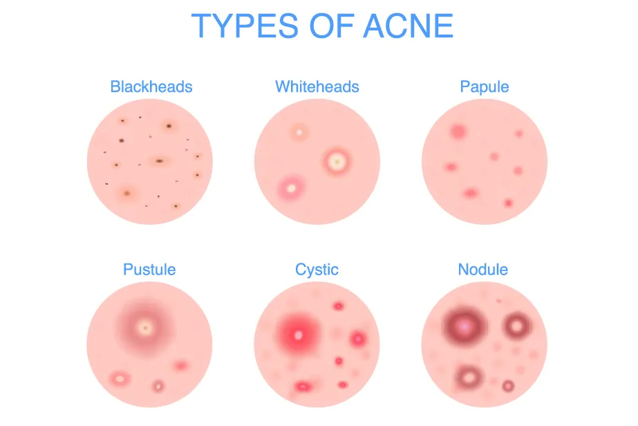 cystic acne