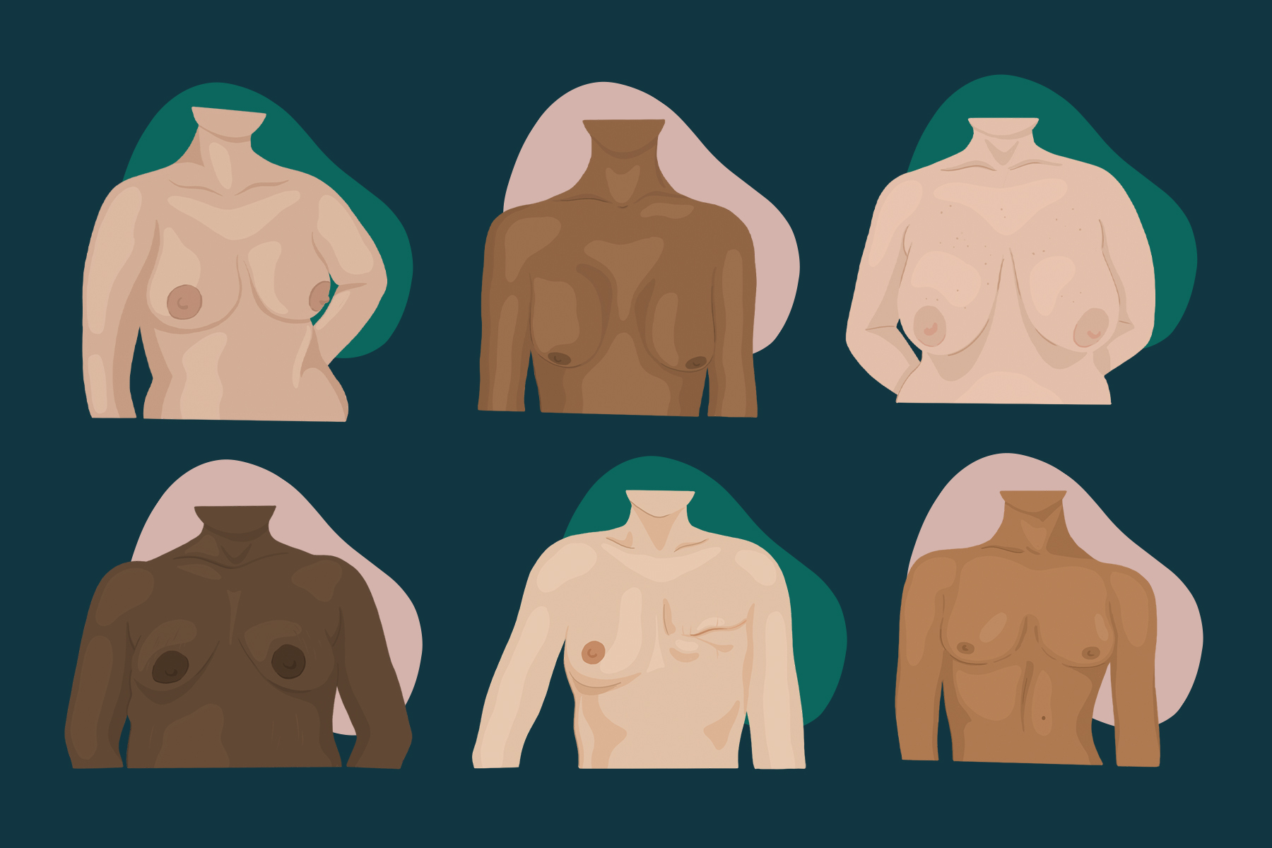 I Started Loving My Uneven Breast Shape After Years Of Hating My