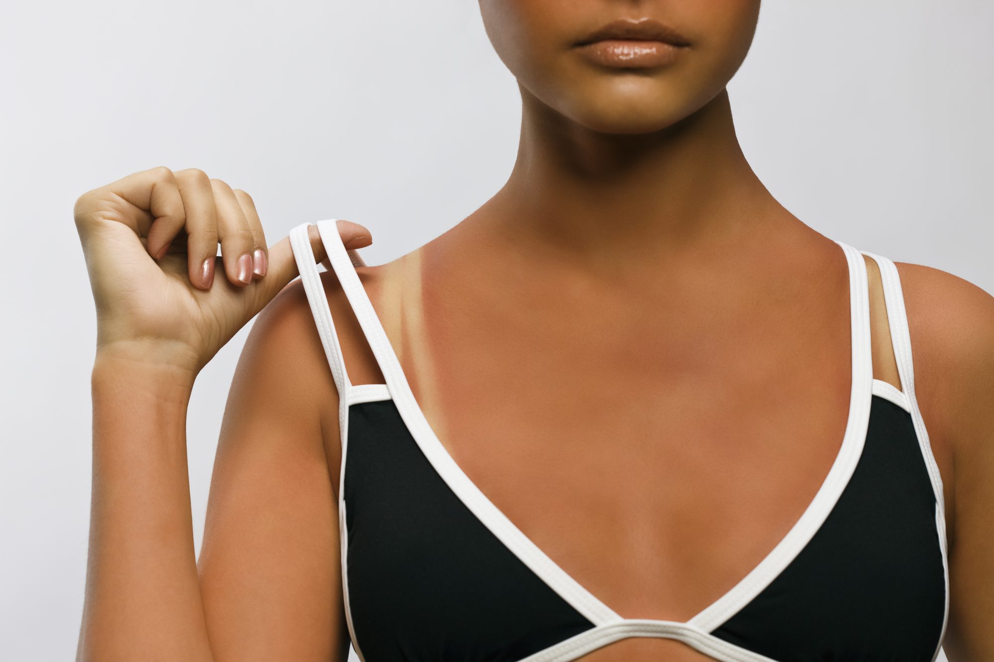 skin health sunburn signs