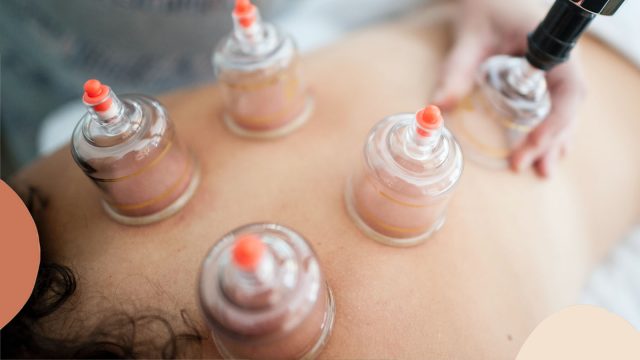 cupping therapy