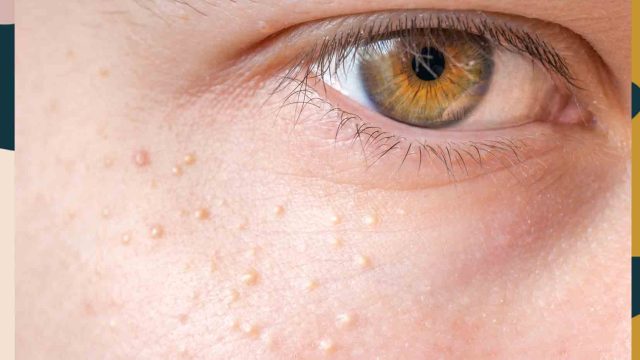 milia treatment prevention