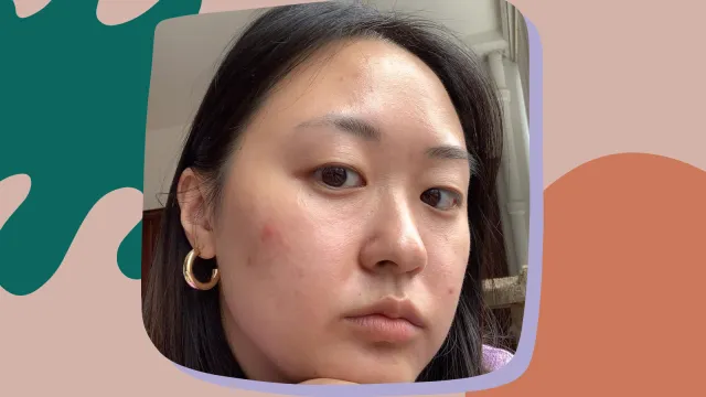 i stopped hiding acne pimples zits on Instagram social media confidence skin neutrality positivity essay