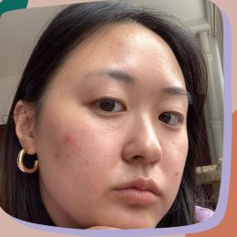 i stopped hiding acne pimples zits on Instagram social media confidence skin neutrality positivity essay