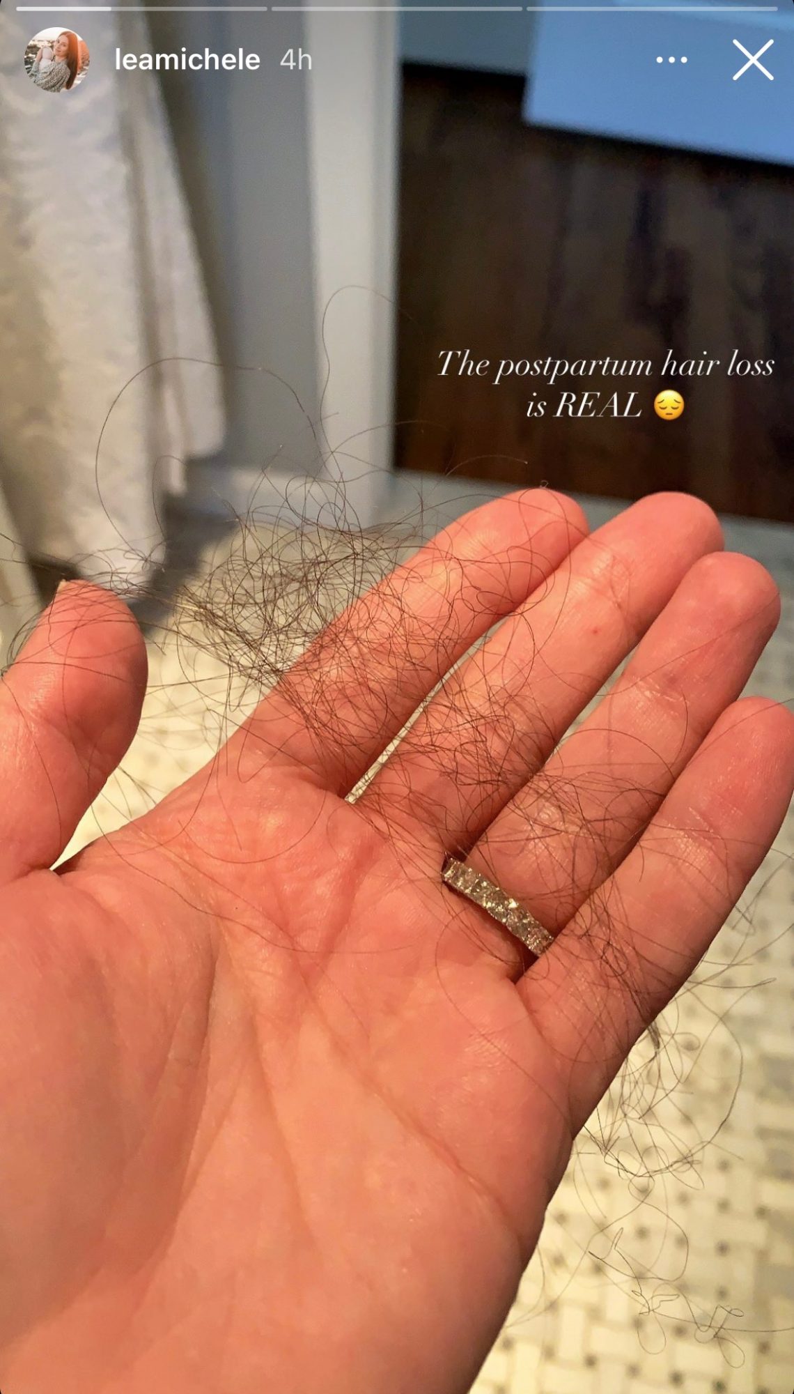Lea Michele hair loss