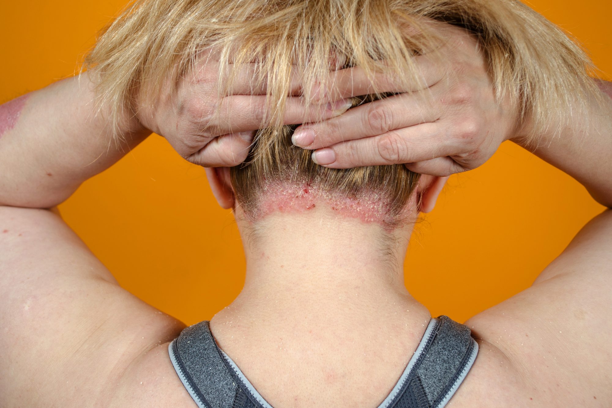 Is Vitamin D Deficiency the Reason for Your Flaky Scalp? - HelloGigglesHelloGiggles Is Vitamin D Deficiency the Reason for Your Flaky Scalp? - HelloGigglesHelloGiggles