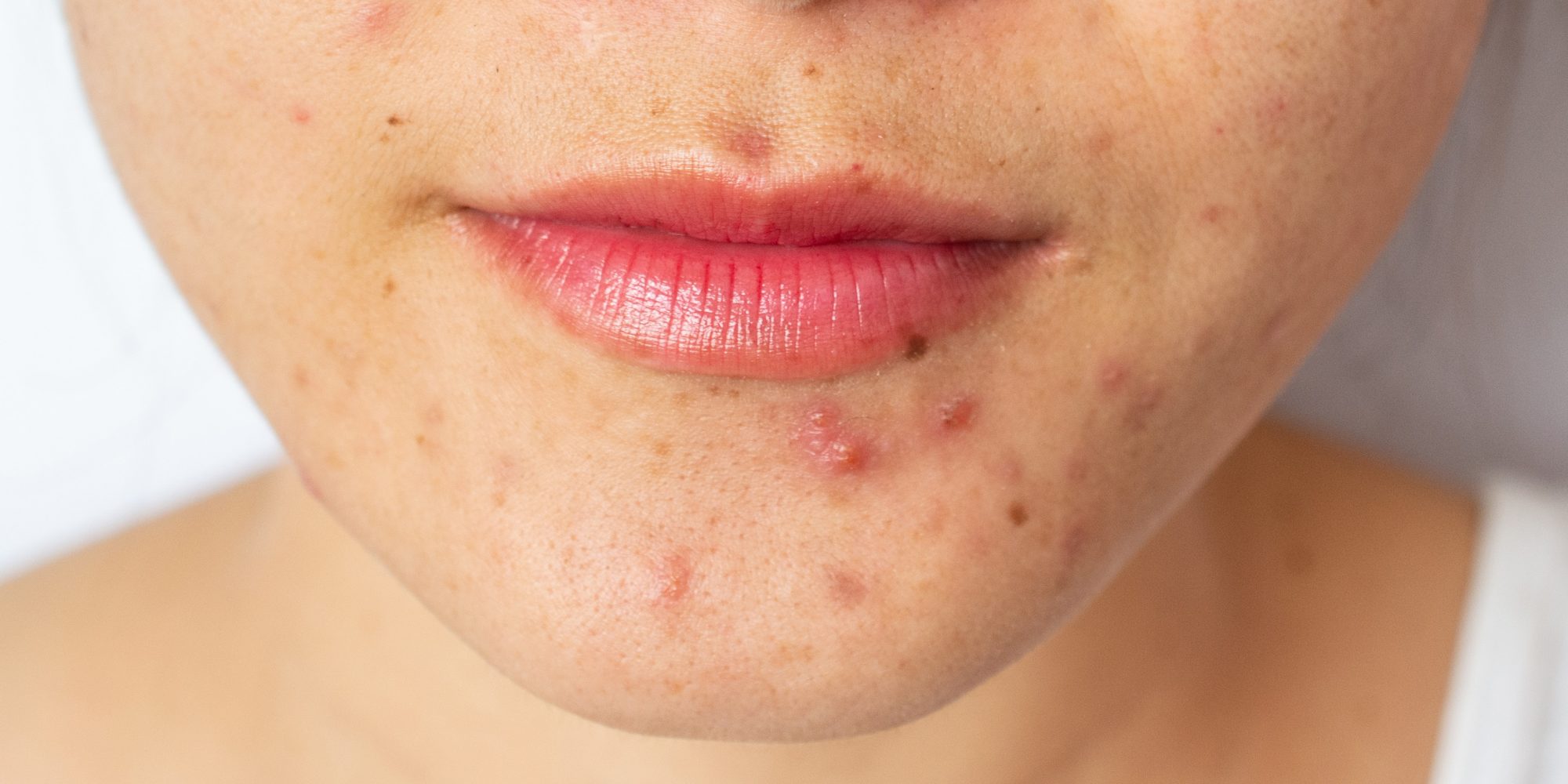skin purging