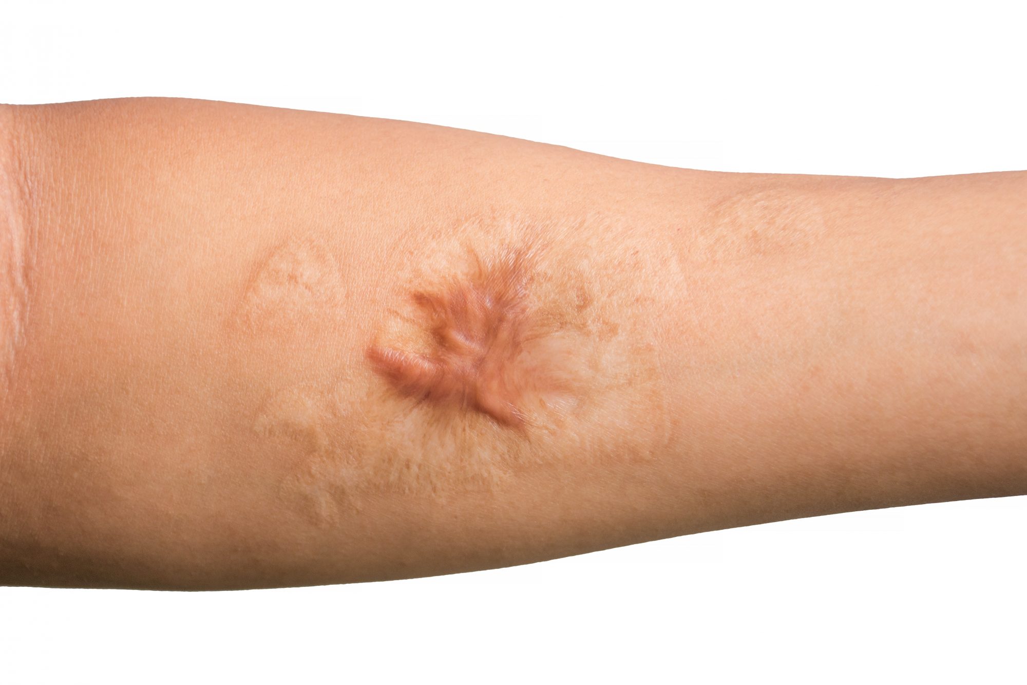 how to heal scars