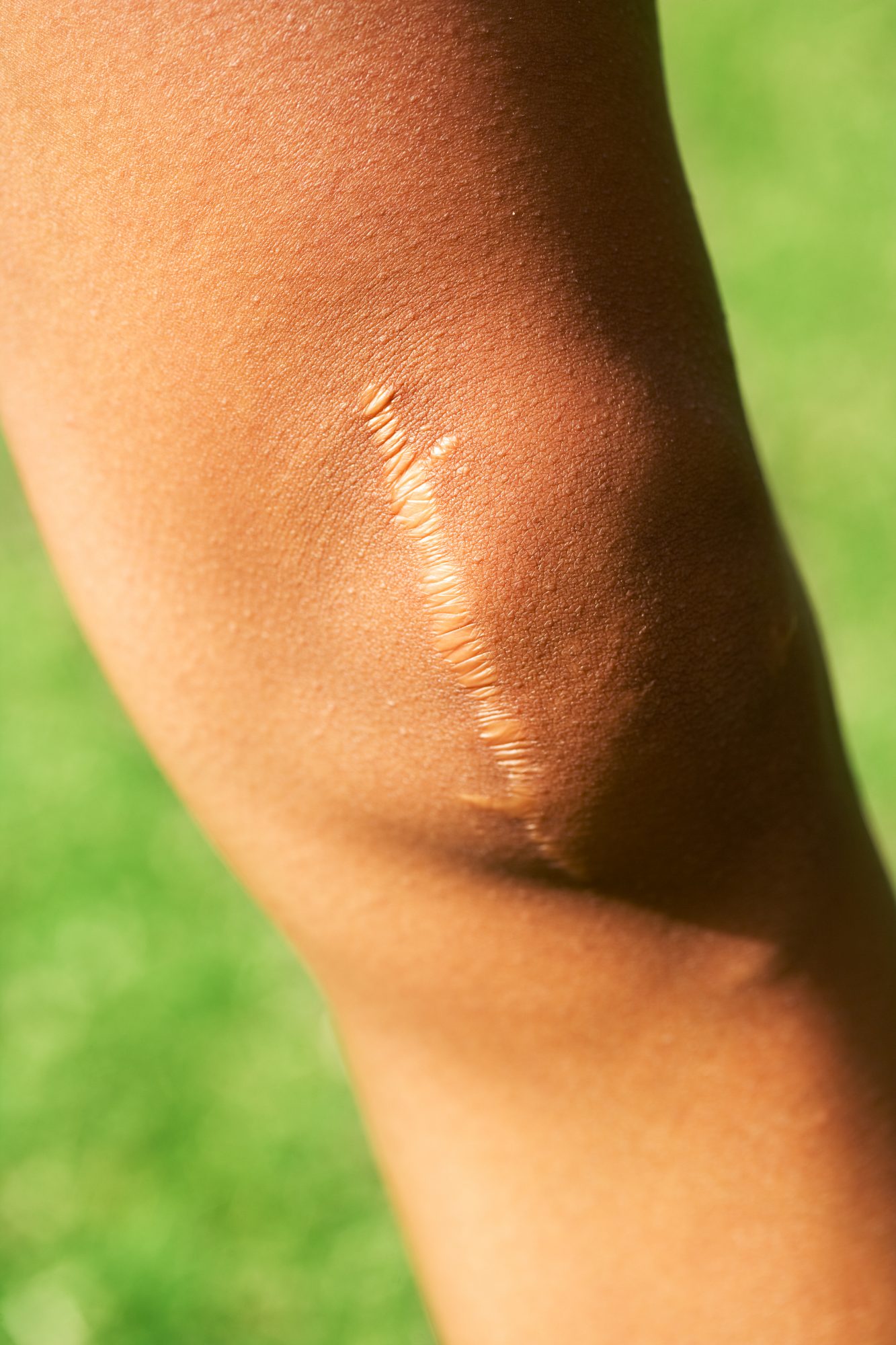 how to heal scars