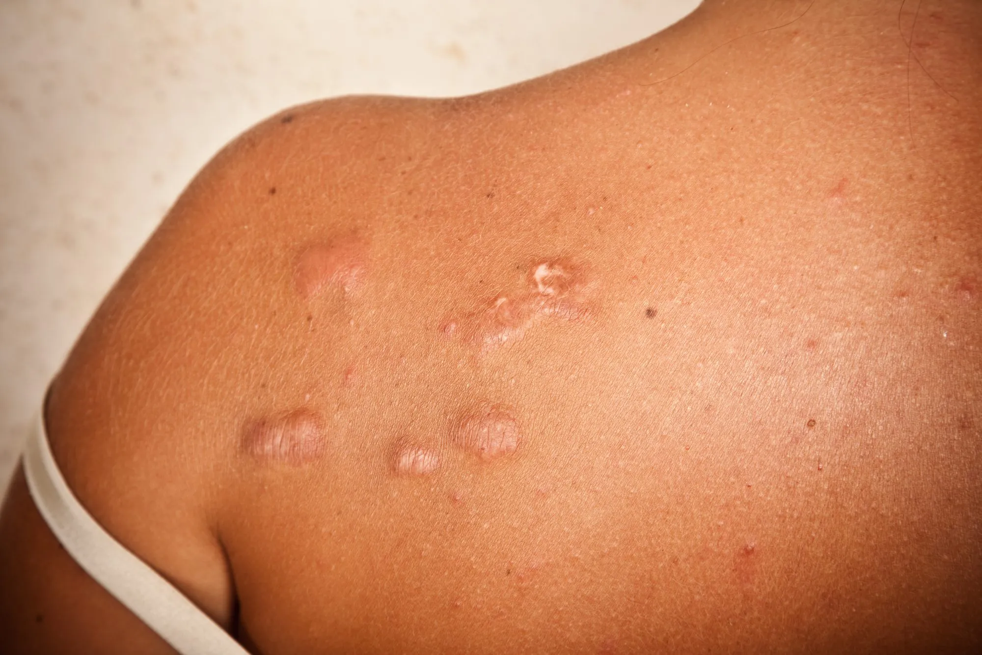 Keloid scar how to heal scars