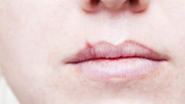 skin emergency cold sore treatment