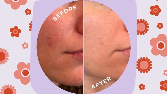 Can 'Face Mapping' Reveal Why You Break Out?! – ZitSticka UK