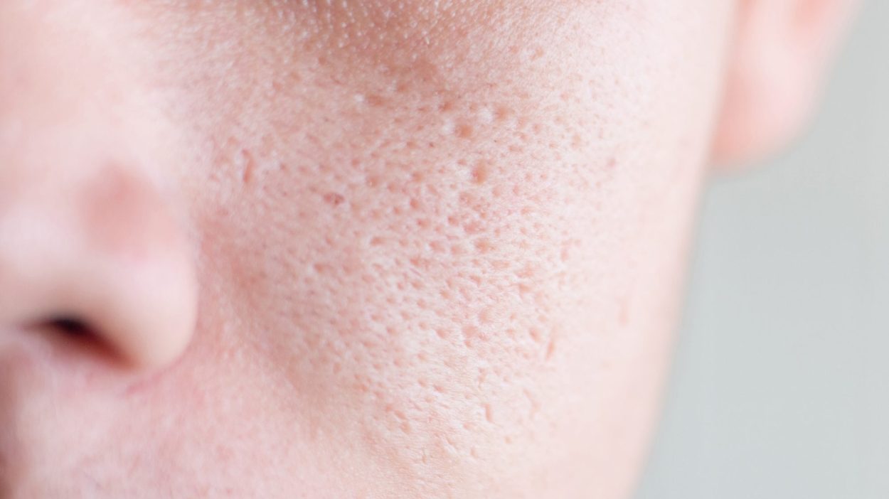 Pore Size What To Know How To Reduce And How To Minimize