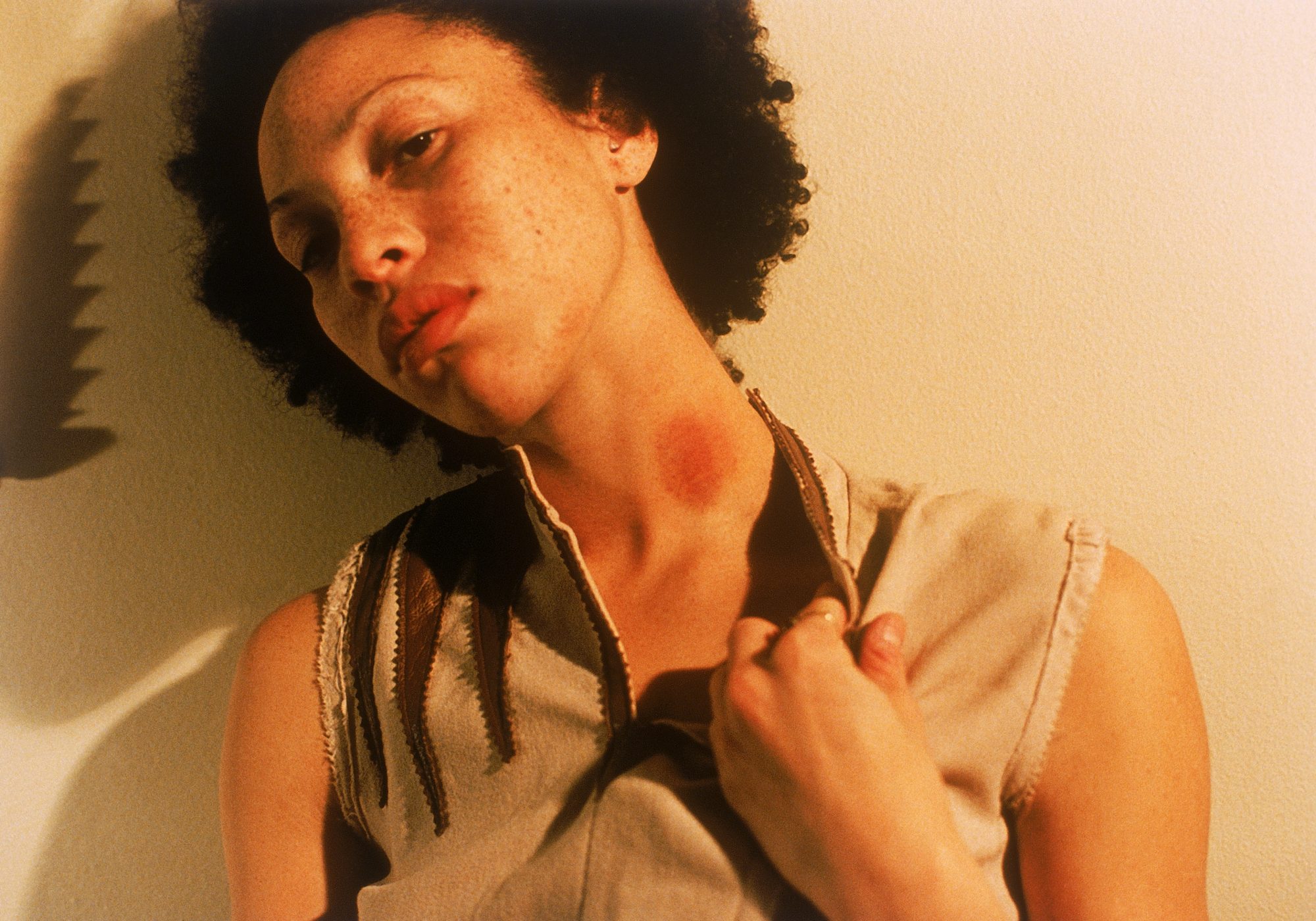 how to get rid of a hickey